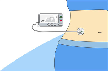 Insulin pump machinery diabetes connected in his abdomen.Concept flat style vector medical illustration_10_EPS10