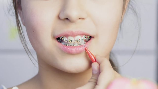 Teen girl cleaning and brushing teeth with clear metal braces