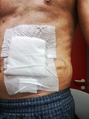 medicated abdomen after surgery