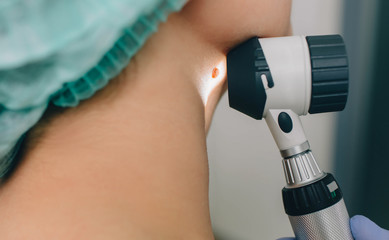 Patient getting laser mole removal. skin moles treatment.