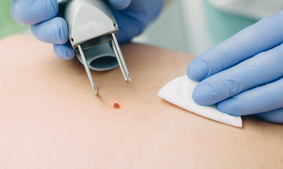 Patient getting laser mole removal. skin moles treatment.