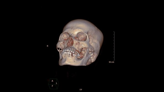CT SCAN of Skull or facial Bone in patient trauma case 3d rendering image  Rotating on the screen . Medical technology concept.