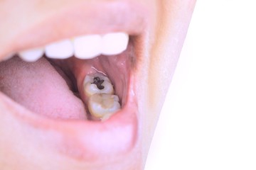 Oral health, tooth decay due to poor cleaning, treatment of tooth fillings.