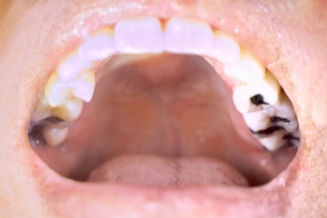 Oral health, tooth decay due to poor cleaning, treatment of tooth fillings.