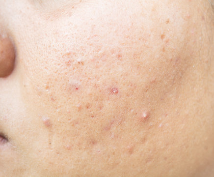 Scar from Acne on face  and Skin problems and pores in teenagers