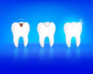 Step of tooth filling. Tooth decay, decay remove and white filling. Illustration isolated on blue background. Dental care concept.
