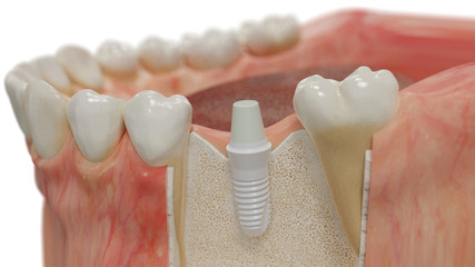 Inseriertes Keramik Implantat im Kieferknochen