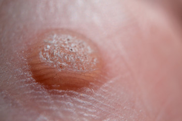 Fototapeta premium Verruca on hand. Moles or warts removing concept
