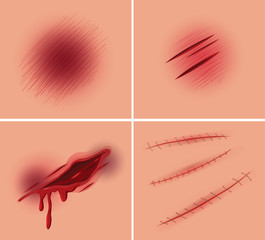 Set of open wound