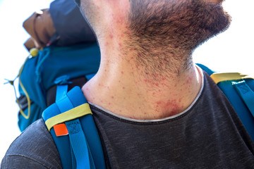 Redness allergy of the skin of a man in nature.