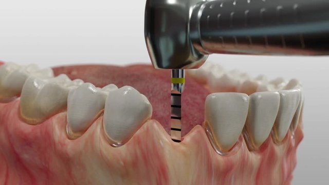 Insertion eines Titan-Vierkant-Implantats im Unterkiefer mit Einsetzen der zahnkrone