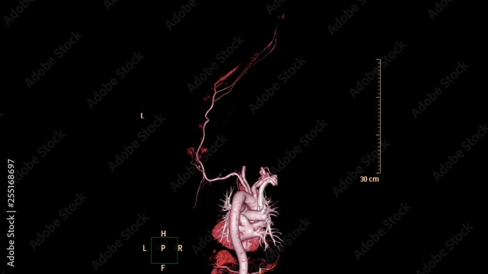 Poster cta brachial artery or ct scan of upper extremity or the arm 3d rendering image with mip technique.