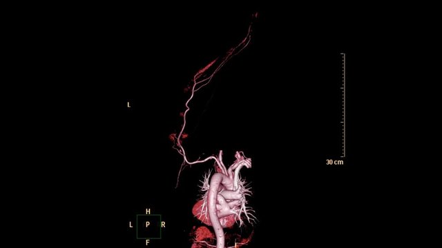 CTA brachial artery or CT scan of upper extremity or the Arm 3d rendering image with MIP technique.