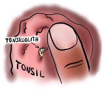 Tonsillolith In Tonsil Crypt