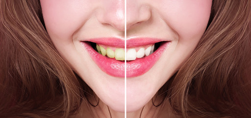 Bleaching of teeth. Before and after.