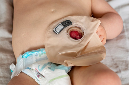 Close-up top view on transparent colostomy pouch attached to baby patient. Ostomy bag with filter. Colostomy surgery. Medical theme.