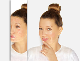 Post-Acne Marks /Treating Acne Scars.Acne Scar Removal