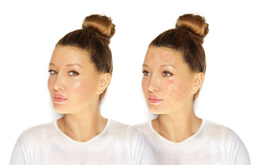 Post-Acne Marks /Treating Acne Scars.Acne Scar Removal