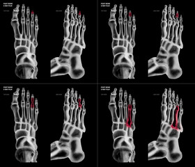 X-ray film collection of Ring toe foot bone with red highlights on different pain and joint...