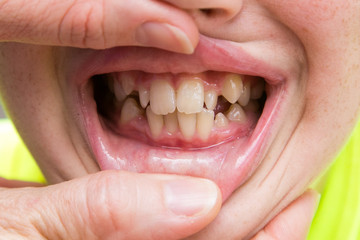 Fototapeta premium Crooked Teeth that Need to Be Fixed and Straightened Using Braces
