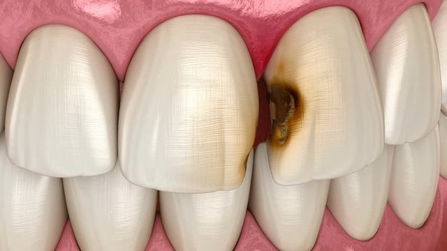Central incisor teeth damaged by caries. Medically accurate tooth 3D animation.