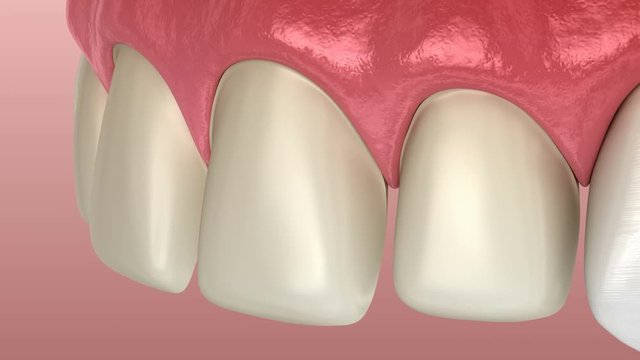 Veneer installation procedure over central incisor and lateral incisor. Medically accurate tooth 3D animation