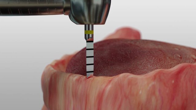 Insertion von Kugelkopf Implantaten zur Fixierung einer herausnehmbaren Prothese mit Prothese