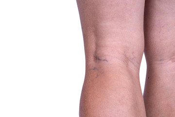 close up of Varicose veins on the woman legs isolate on white background with clipping path. Rear view. Vascular disease,varicose veins problems, health care and medical concept.