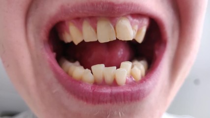 European male opens a mouth and shows crooked yellow teeth dry lips