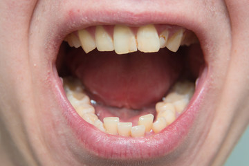 European male open mouth crooked yellow teeth dry lips