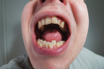 European male open mouth crooked yellow teeth dry lips