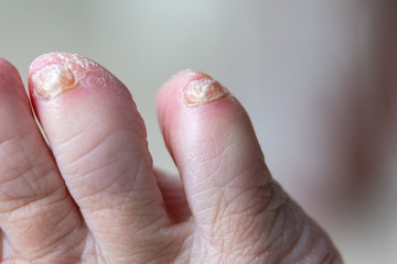 Fungal nail infection on human foot.
