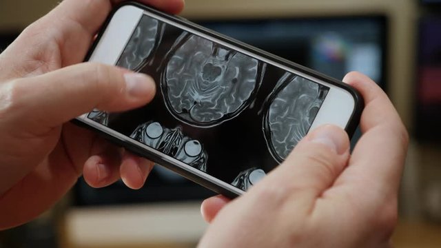 A doctor examines a brain scan MRI on a smartphone. Top-down view version.  	