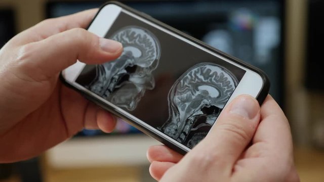 A doctor examines a brain scan MRI on a smartphone. Profile version.  	