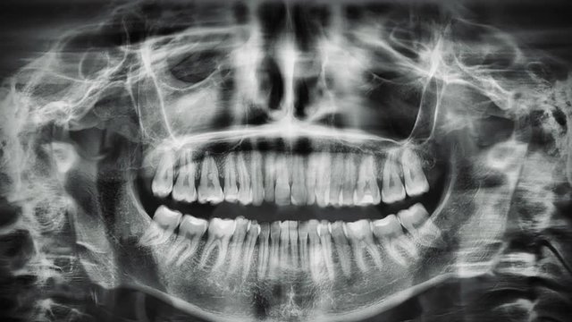 Talking jaw x-ray. Animation of moving roentgen of teeth.