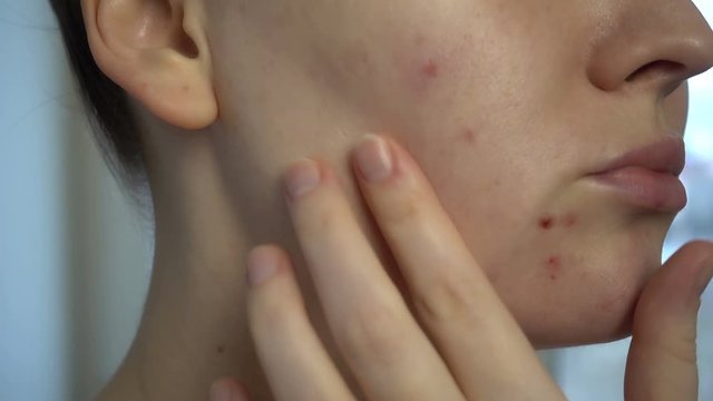 Close up of skin problems (unhealthy skin with acne and pimples). Treatment of problem skin.