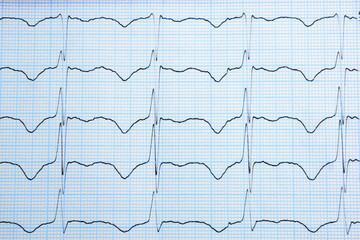 cardiogram graph paper background