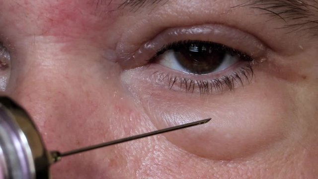 Treatment with injection of the diseased eye. A experiment with Wrinkle Remove.