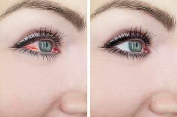woman red eye before and after - obrazy, fototapety, plakaty