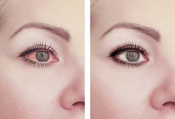 woman red eye before and after