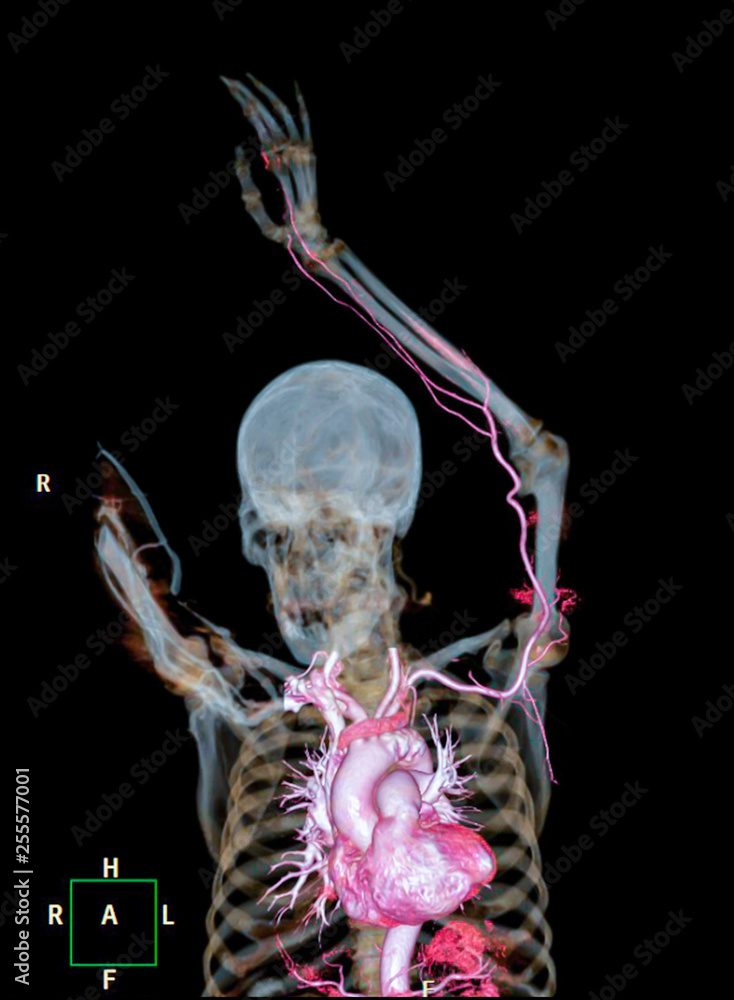 Poster cta brachial artery or ct scan of upper extremity or the arm 3d rendering image with mip technique.