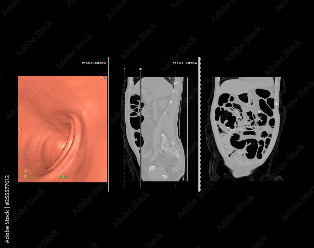 Aufkleber ct colonography or ct scan of colon 3d rendering image comparison with sagittal view vs coronal view