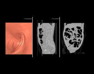 CT colonography or CT Scan of Colon 3D rendering image comparison with sagittal view vs Coronal...