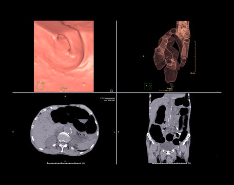 CT colonography or CT Scan of Colon axial view vs Coronal view and 3D rendering image on the screen.