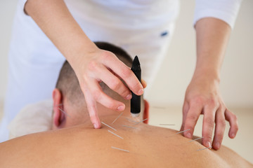 moxibustion and acupuncture treatment