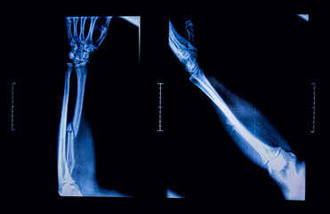 Arm fracture seen on X -ray