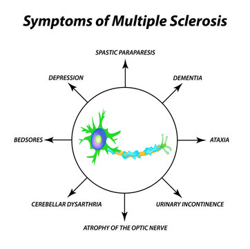 Symptoms of multiple sclerosis. The destruction of the myelin sheath on the axon. Damaged myelin. World Multiple Sclerosis Day. Infographics. Vector illustration on isolated background.