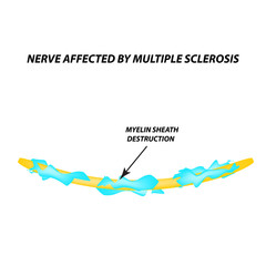 The destruction of the myelin sheath on the axon. Damaged myelin. Neuron affected by multiple sclerosis. World Multiple Sclerosis Day. Infographics. Vector illustration on isolated background.