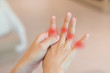 Overuse hand problems. WomanÃ¢ÂÂs hand with red spot o fingers as suffer from Carpal tunnel syndrome. The symptoms of tingling, numbness, weakness, or pain of the fingers and wrist.