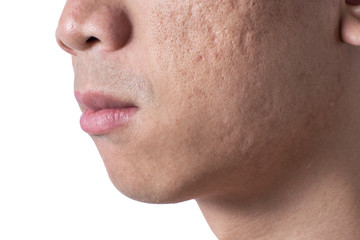 Close-up acne and scars on asian man face, isolated white background